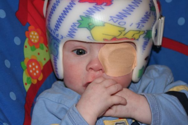 Young Zachary pictured with a helmet that redirected the pressure of the excess brain fluid cause by the hydrocephalus. The helmet worked to prevent any deformities, as the bones in the skull are not fully fused as a baby.